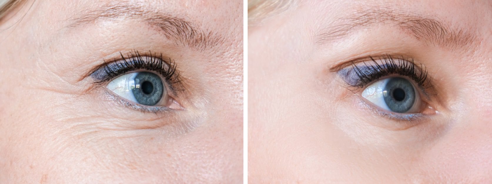 dermal filler before and after around eyes